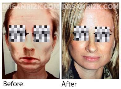 Female face, before and after Facelift and necklift treatment, front view, patient 13
