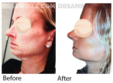 Female face, before and after Facelift and necklift treatment, side view, patient 13