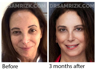 5 th Ave plastic New York plastic surgeon chose Dr Rizk and underwent deep plane facelift / necklift/ browlift and blepharoplasty and sent her picture 3 months post and 6 months post. It's a testament that plastic surgeons chose Dr Rizk for their facelifts.