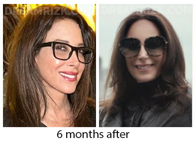 5 th Ave plastic New York plastic surgeon chose Dr Rizk and underwent deep plane facelift / necklift/ browlift and blepharoplasty and sent her picture 3 months post and 6 months post. It's a testament that plastic surgeons chose Dr Rizk for their facelifts.