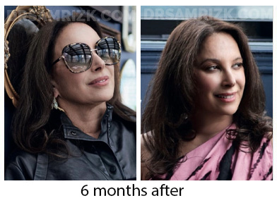 5 th Ave plastic New York plastic surgeon chose Dr Rizk and underwent deep plane facelift / necklift/ browlift and blepharoplasty and sent her picture 3 months post and 6 months post. It's a testament that plastic surgeons chose Dr Rizk for their facelifts.