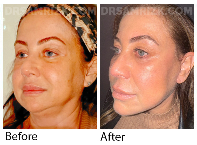 Patient is 2 weeks post deep plane facelift / deep necklift. Although she is still swollen and still healing , it shows jawline definition and the rapid recovery of Dr Rizk drainless facelift with tissue glue.