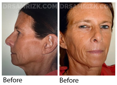 55 yo patient sent her own pictures 3 months post deep plane facelift , deep necklift , upper blepharoplasty , temporal browlift & laser