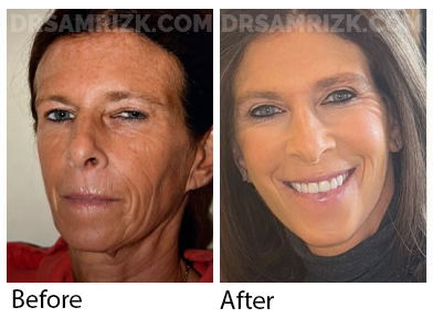 55 yo patient sent her own pictures 3 months post deep plane facelift , deep necklift , upper blepharoplasty , temporal browlift & laser