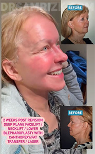 This patient is 2 weeks after deep plane facelift /deep necklift / lower blepharoplasty with canthopexy / temporal browlift / fat transfer and laser. She looks vibrant . Eyes look happy not sad. Jawline is defined and she is healing great. Laser pinkness will fade over next several days.