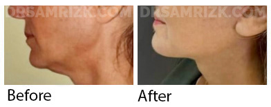 This patient is 1 year post deep plane facelift / deep necklift / rhinoplasty / browlift / blepharoplasty.