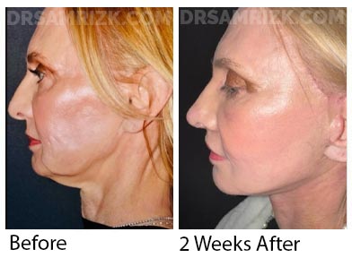 60 yor female cardiologist who was a unique patient having had a previous facelift and permanent filler damage to her face . She was refused by 6 reputable surgeons . She is shown 2 weeks after Dr Rizk did a revision deep plane facelift / deep necklift / revision rhinoplasty with rib MTF tip support / bullhorn lip lift / laser / PRP. Note jawline definition and a more youthful lifted noses and better nose-lip distance