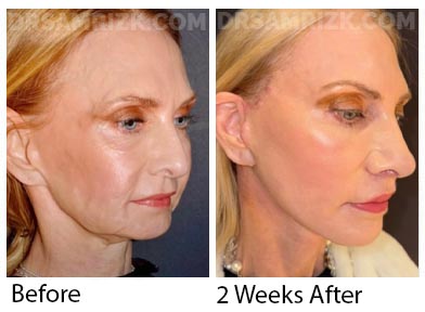 60 yor female cardiologist who was a unique patient having had a previous facelift and permanent filler damage to her face . She was refused by 6 reputable surgeons . She is shown 2 weeks after Dr Rizk did a revision deep plane facelift / deep necklift / revision rhinoplasty with rib MTF tip support / bullhorn lip lift / laser / PRP. Note jawline definition and a more youthful lifted noses and better nose-lip distance