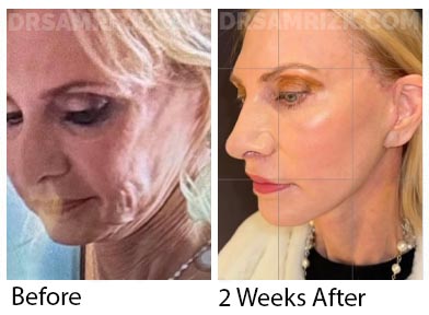 60 yor female cardiologist who was a unique patient having had a previous facelift and permanent filler damage to her face . She was refused by 6 reputable surgeons . She is shown 2 weeks after Dr Rizk did a revision deep plane facelift / deep necklift / revision rhinoplasty with rib MTF tip support / bullhorn lip lift / laser / PRP. Note jawline definition and a more youthful lifted noses and better nose-lip distance