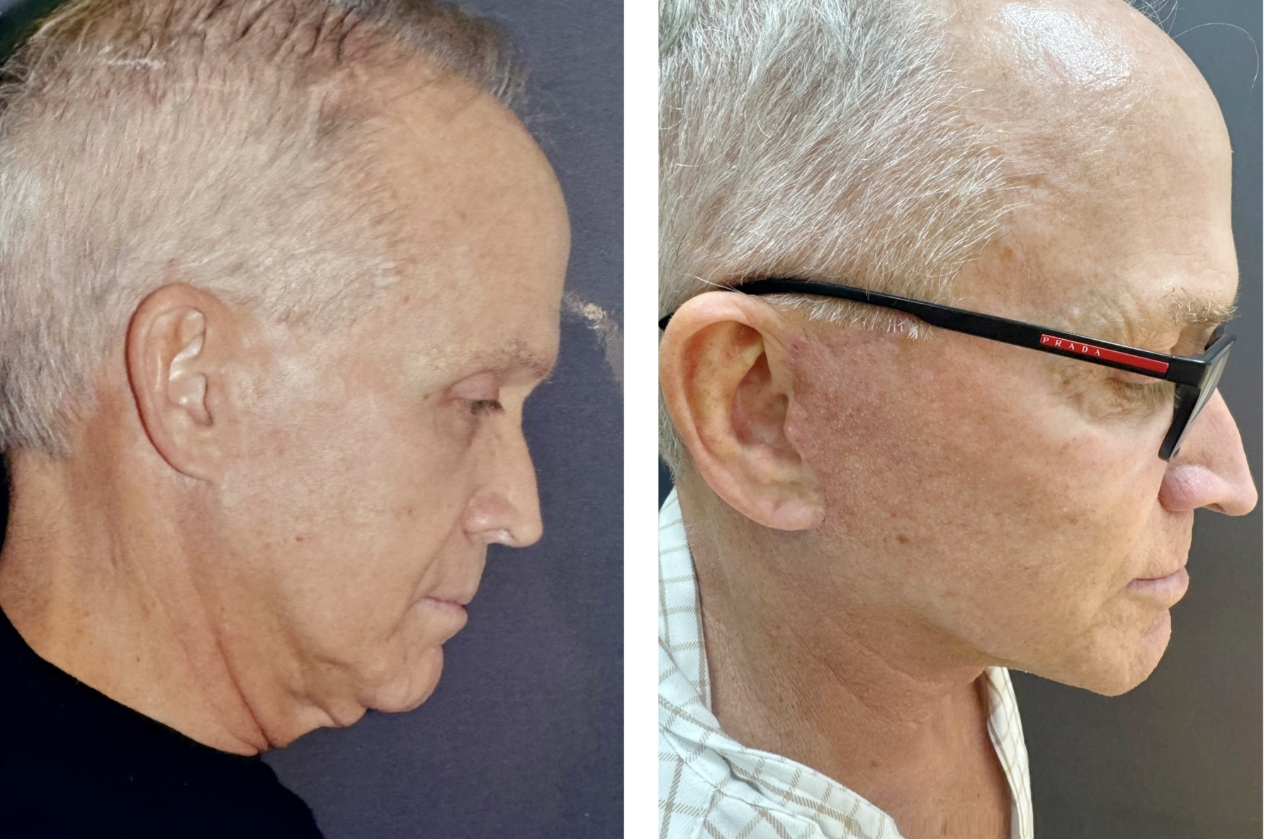 66 yo patient looking amazing one year after deep plane facelift / deep necklift / platysmaplasty / temporal browlift and fat transfer to cheek area / lower eyelids . Patient has great jawline and youthful cheeks looks 20 years younger