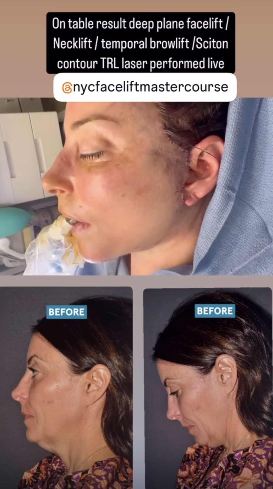 This is a patient from a surgery I performed live at the NYC Facelift Masterclass Conference in New York; this is the second conference in which I did a live deep plane facelift this year. This is the result on the operating room table. More pictures to come!