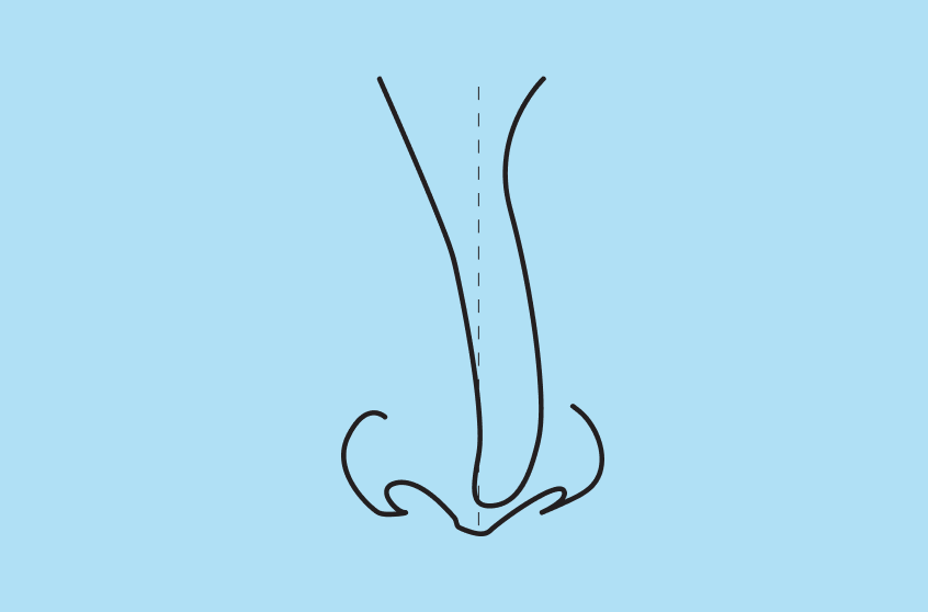 What Is a Crooked Nose?