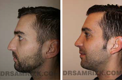 Before and After