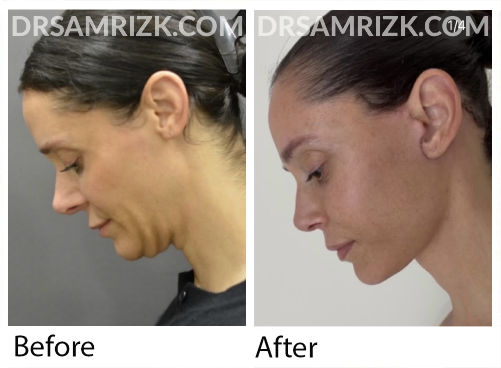 This 41 yo patient shown 2 weeks post deep plane facelift / Necklift 2